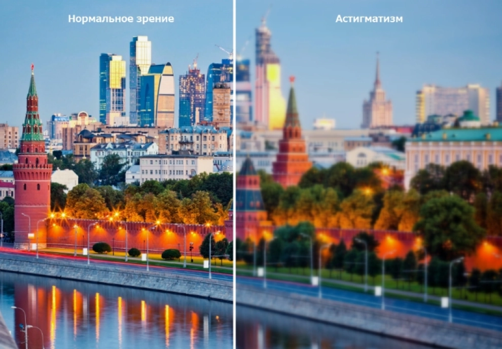 Астигматизм: причины, симптомы, лечение