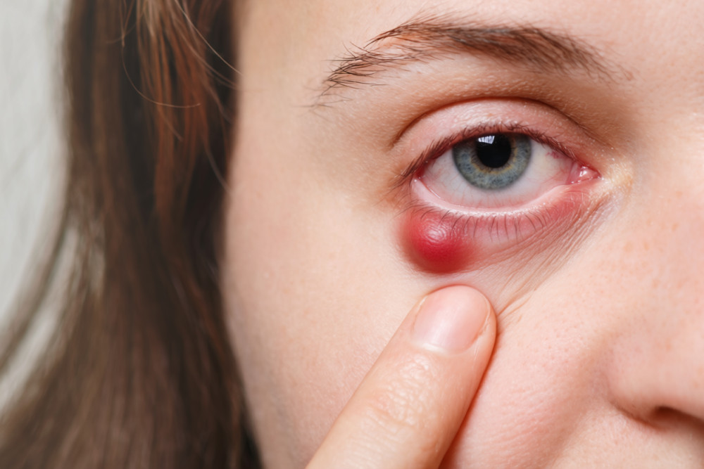 Как лечить ячмень на глазу: быстрые и безопасные способы