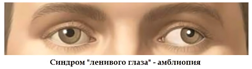 Амблиопия («ленивый глаз»)