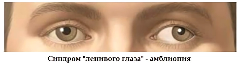 Амблиопия («ленивый глаз»)