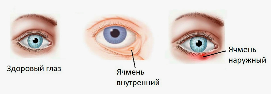 разновидности ячменя на глазу