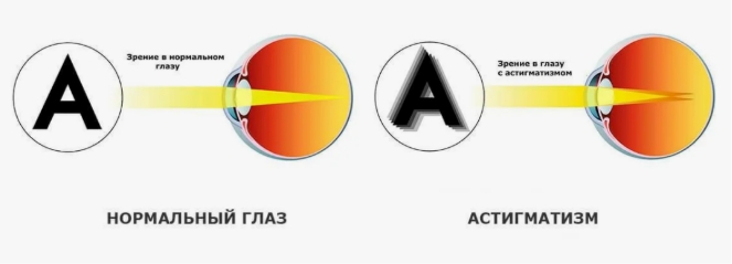 как видят буквы при астигматизме