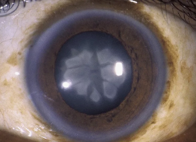 ядерная катаракта фото