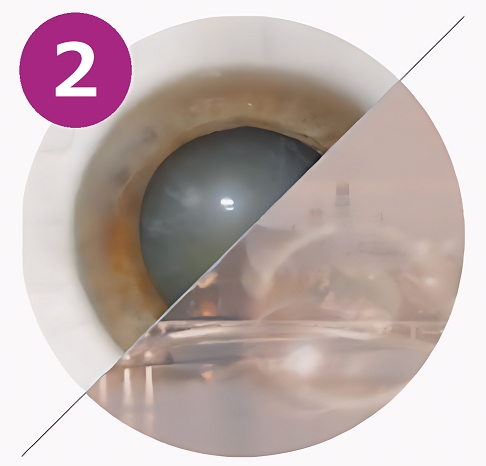 незрелая стадия катаракты фото