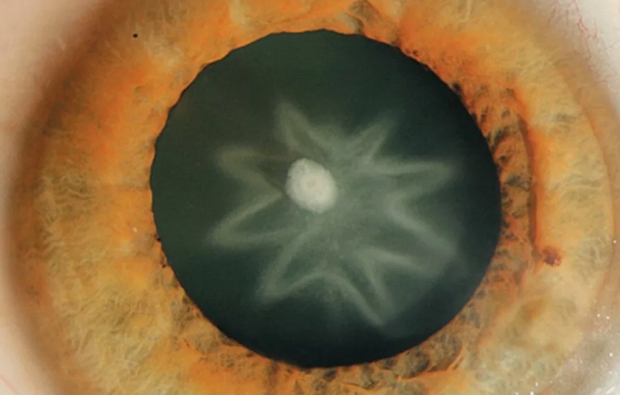 переднекапсулярная катаракта фото