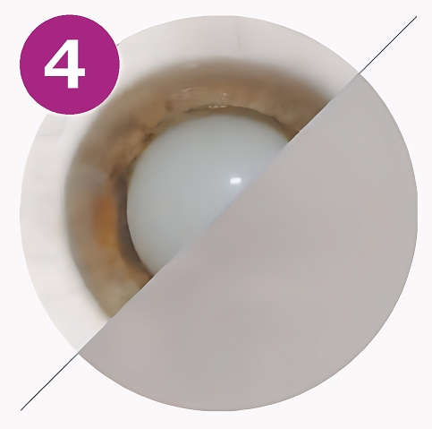 перезрелая молочная стадия катаракты фото