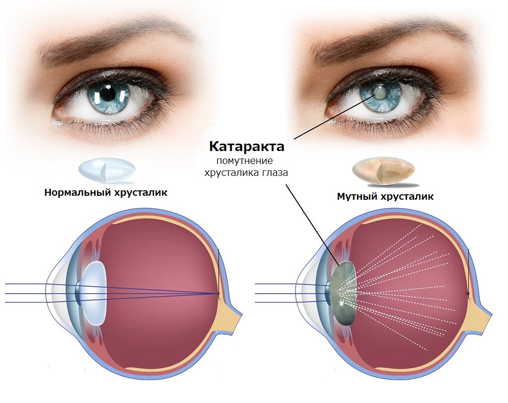 схема катаракта