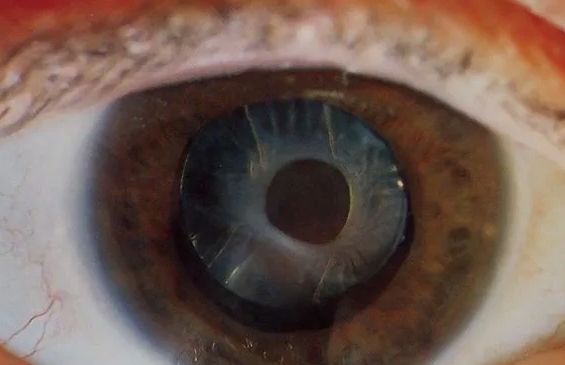 заднекапсулярная катаракта фото