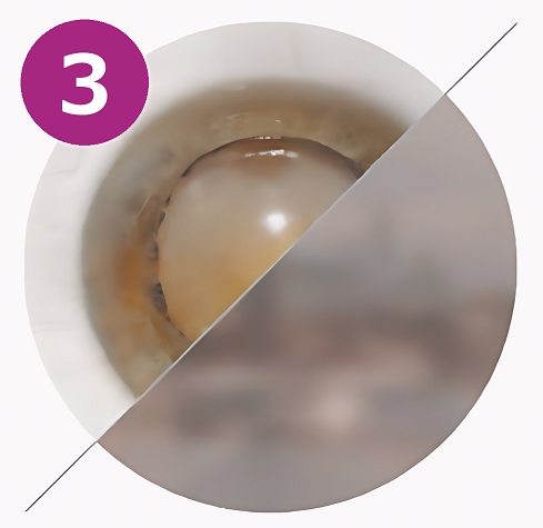 зрелая стадия катаракты фото