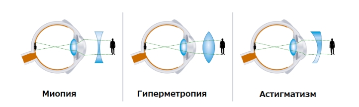 линзы при астигматизме