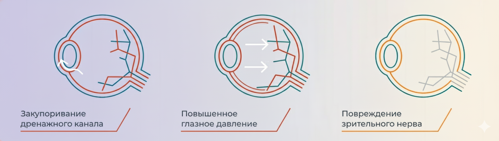 причины развития глаукомы фото