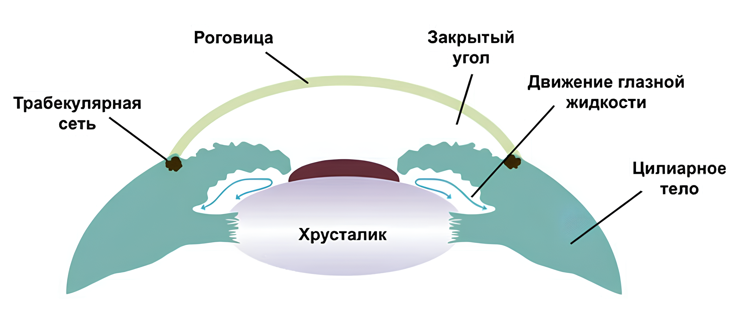 закрытоугольная глаукома фото