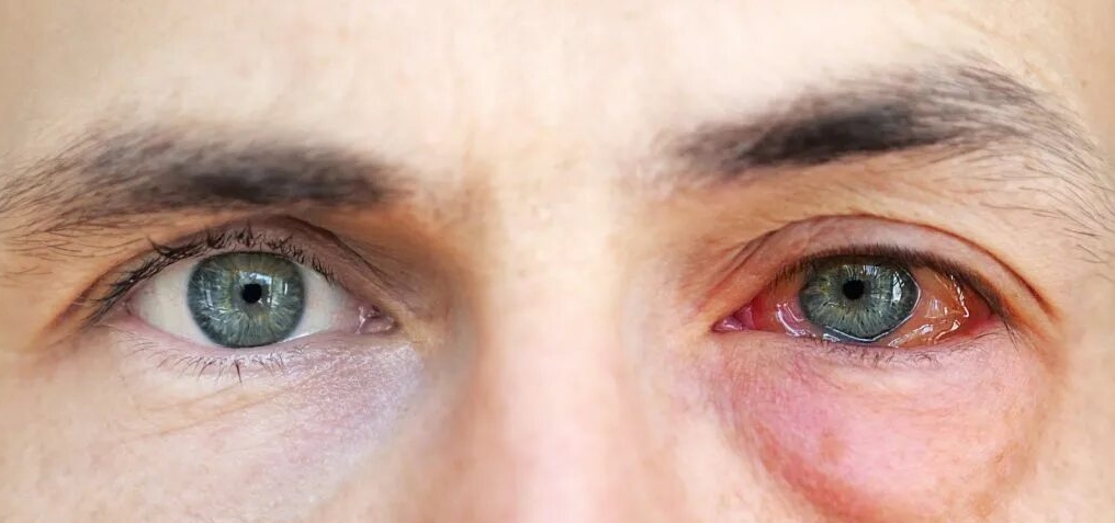 аллергический конъюнктивит